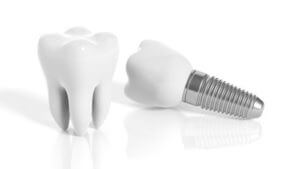 dental-implants