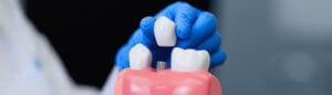 dental implants