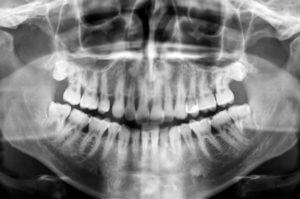 pdenxray